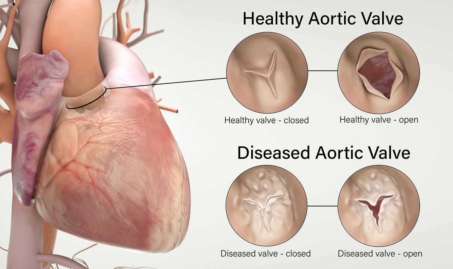 What Is The Best Treatment For Severe Aortic Stenosis